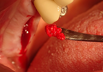 Piezo kirurgija – široki spektar aplikacija u oralnoj kirurgiji